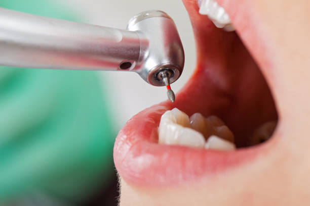 Best Urgent Care for Lost Fillings or Crowns in Woodmoor, CO
